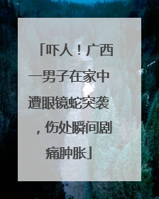 吓人！广西一男子在家中遭眼镜蛇突袭，伤处瞬间剧痛肿胀